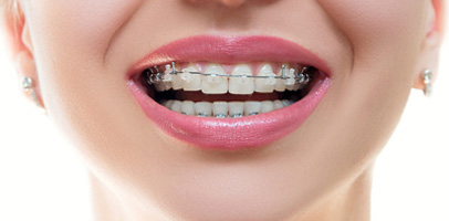 Metal and Ceramic dental braces for maligned teeth
