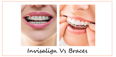 Braces Vs Invisalign - Summit Dental & Orthodontics